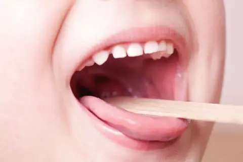 Bocca di bambino aperta con linguetta di legno per controllare la gola. Informazioni sulla faringite bambini quanto dura.
